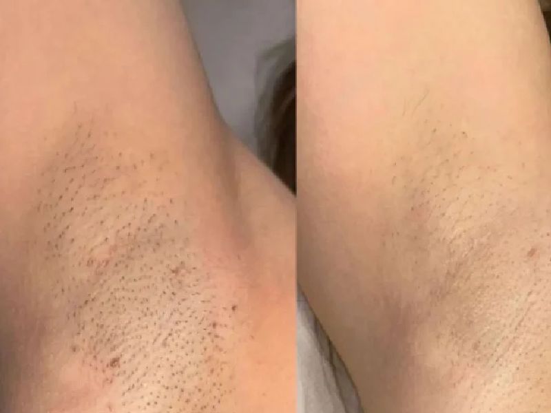 اهمیت جلسه اول لیزر چیست؟