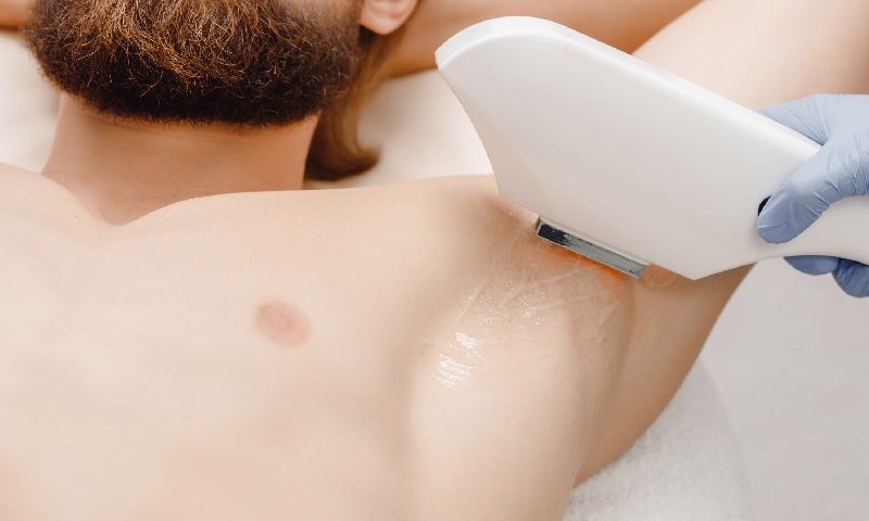 تعداد جلسات لیزر موهای زائد در کرج