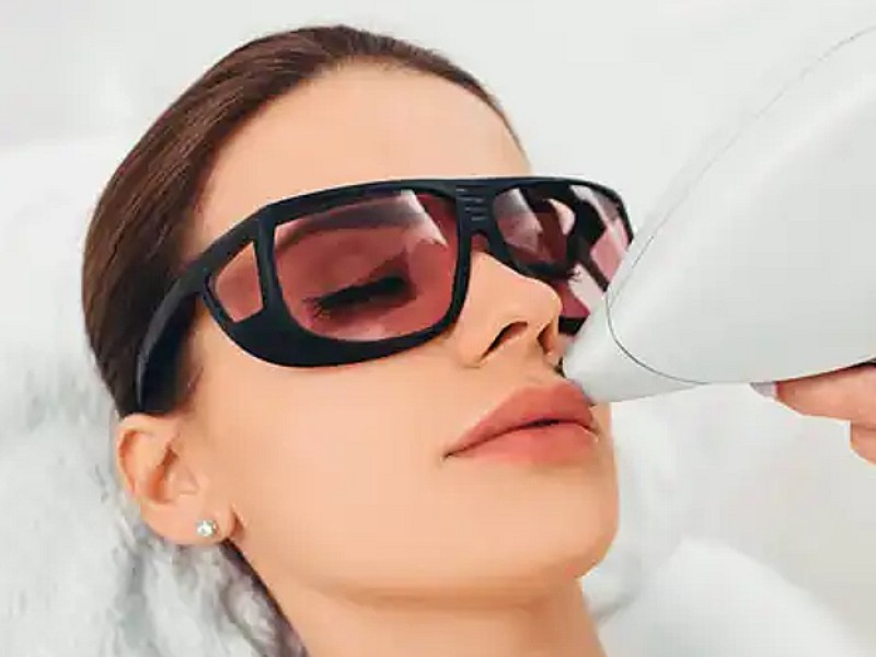 لیزر موهای زائد در کرج