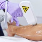 از بین بردن موهای زائد با لیزر