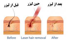 از بین بردن موهای زائد با لیزر چه مزیت هایی دارد؟