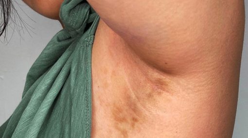 لک های قهوه ای پس از لیزر موهای زائد